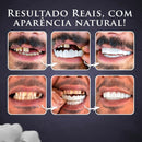 Nature Smile® - Facetas Dentárias Removíveis